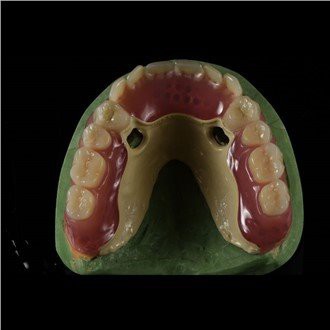 Каркасный протез Peek