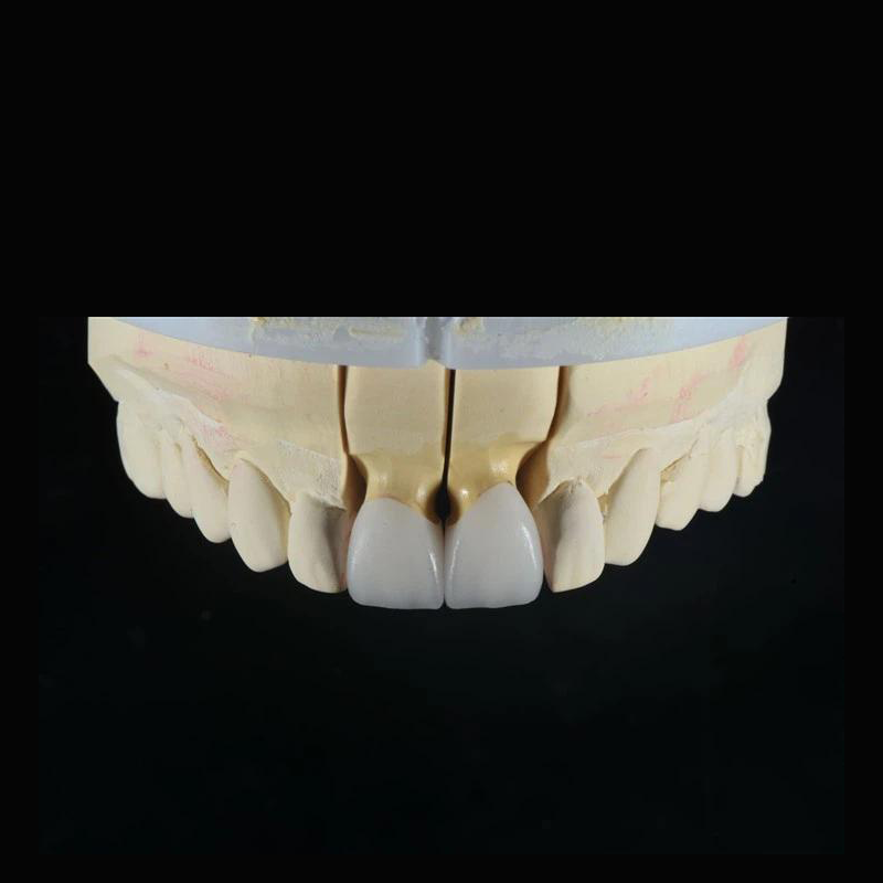 Natural Looking And Aesthetic Emax Crown