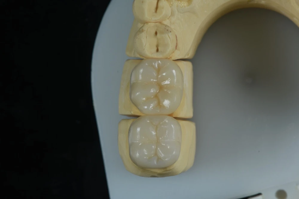 E.max inlay solution for minimally invasive dentistry E.max inlay solution for minimally invasive dentistry