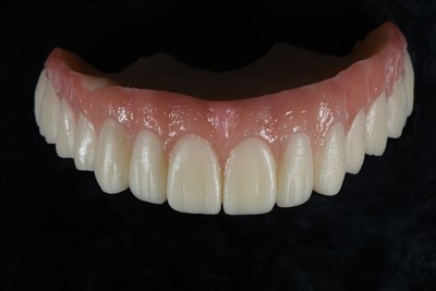 Временная коронка из акриловой смолы